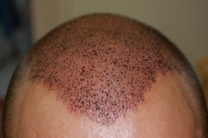 hårtransplantation